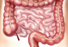Rakovina tlustého střeva v ČR ročně zabije 3 500 lidí rakovina tlustého střeva