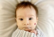 Hemangiomy u kojenců lze úspěšně léčit