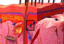 Nádor z Merkelových buněk je vzácný, ale o to horší