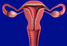 Riziko rakoviny vaječníků snižují laktobacily riziko rakoviny vaječníků A