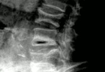 Osteoporóza ohrožuje mnoho lidí. Ne všichni to ale vědí osteoporóza