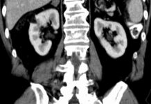 Rakovina ledvin postihuje více muže než ženy rakovina_ledvin