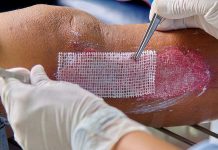 Náplasti z lidské membrány budou dostupné i v Česku naplasti