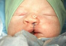 Na rozštěp obličeje u dětí se specializují ve FN Brno rozstep_obliceje