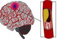 Příznaky cévní mozkové příhody odhaluje metoda FAST cevni_mozkové_prihody