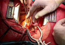 Lékaři VFN provedli již 400 endarterektomii plicnice VFN