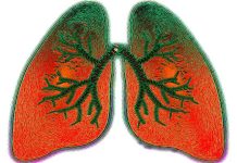 Cizinci v Česku jsou k TBC náchylní i kvůli slabší imunitě TBC