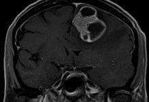 Rakovina plic v mnoha případech metastazuje do mozku rakovina_plic
