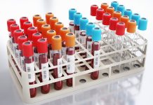 HIV loni screening zachytil u šesti dárců krve a plazmy loni