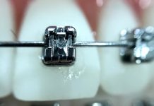 S úhradou rovnátek pomáhá rodičům i stavební spoření stavebni_sporeni