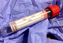 Na opičí neštovice v EU zemřeli první dva muži na_opici