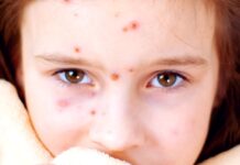 Milionům dětí na světě chybí očkování proti spalničkám spalnicky