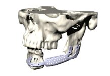 Nádor čelistní kosti řeší lékaři moderními implantáty nador