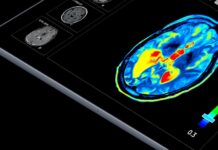 Český startup pracuje na AI detekci Alzheimerovy nemoci Alzheimerovy_nemoci