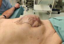 Už i velké břišní kýly se v ČR operují s menšími dopady na pacienta brisni_kyly