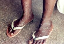 Virus opičích neštovic mutuje a snáze se šíří. Kongo hlásí 300 obětí opicich_nestovic