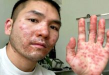 Opičí neštovice jsou riziko po každém pochodu hrdosti opici_nestovice