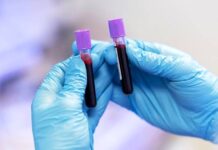 Na nádor slinivky upozorní změny v lipidech, poznají se z krve nador_slinivky