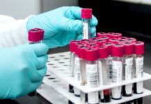 Vědci: Lepší je test lipoproteinů než samotného cholesterolu cholesterolu