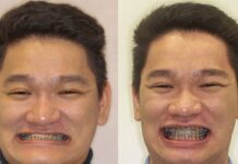 Spánkovou apnoe někdy zapříčiní i špatně usazené čelisti celist