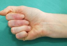 Uříznutý prst nepatří do vody ani do ledu, upozorňují chirurgové uriznuty_prst