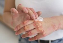 Spouštěč lupénky je stres, ale i nadváha. Nejvíc škodí břišní tuk lupenky