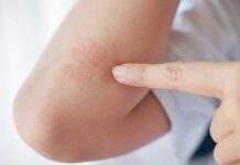 Na léčbu lupénky vydala ČPZP loni téměř 200 milionů korun lupenky