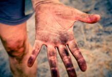 Žloutenka je nejvíc v Praze a okolí. Příspěvek na očkování se nezvedne prispevek