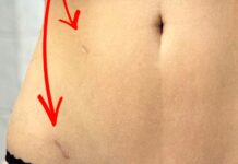 V Písku drobné rány nešijí, ale lepí je. Nejčastěji u laparoskopických výkonů laparoskopických