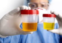 Nádor močového měchýře může odhalit i test moči. V UK ho testují nador_mocoveho_mechyre